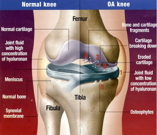 Diagramme démontrant la configuration normale du genou par rapport aux genoux arthritiques 